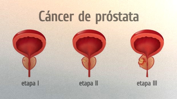 Una dieta muy alta en grasas y exposición a antiadherentes se relacionan con aparición del cáncer de próstata